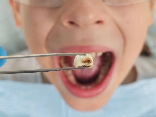 Best Emergency Dentist for Knocked-Out Tooth in Blissfield, MI