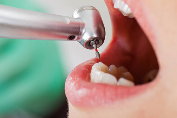 Best Emergency Root Canal Treatment in Blissfield, MI